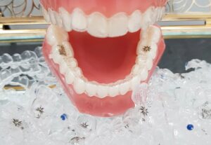 Invisalign Dental 2