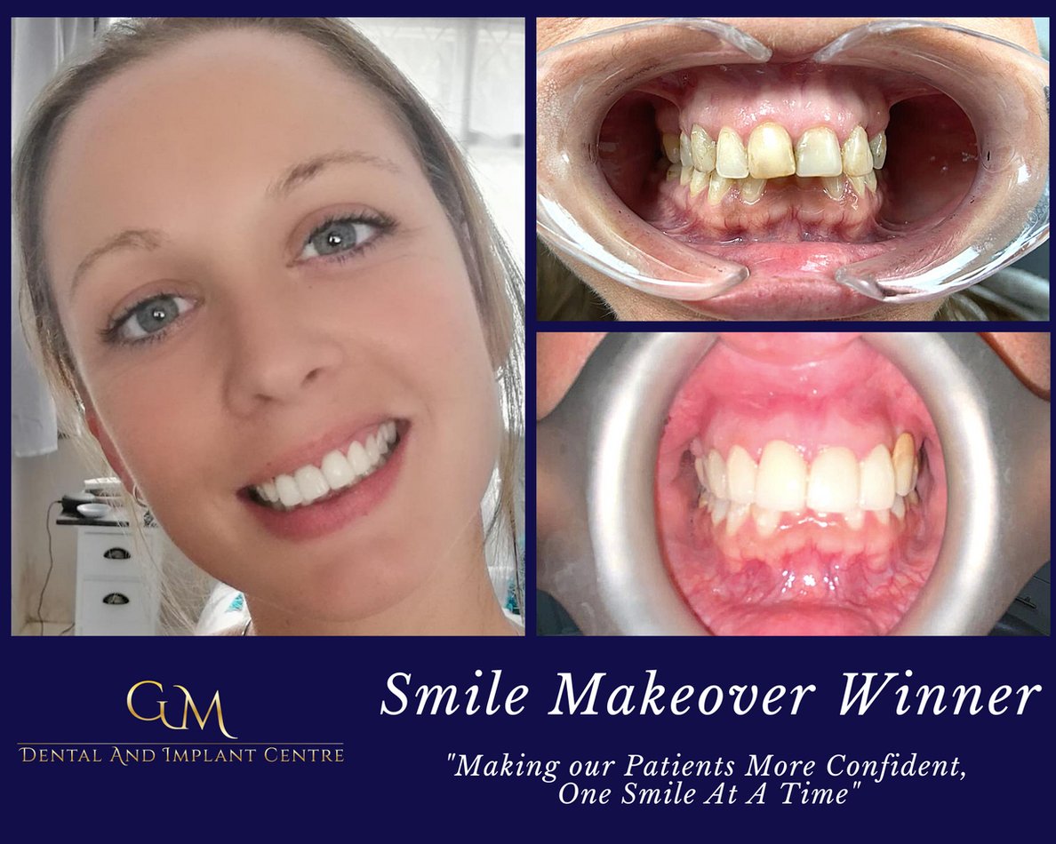Smile Makeover Winner May 2020 (London) Ashford & Rochester