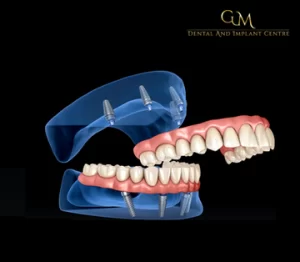 Smile In A Day Or All-On-Four