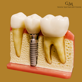 Dental Implant