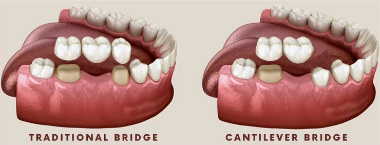 Cantilever Dental Bridge Facts