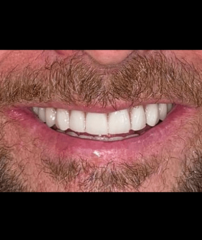 After - GM Dental & Implant Centre