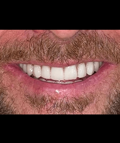 After - GM Dental & Implant Centre