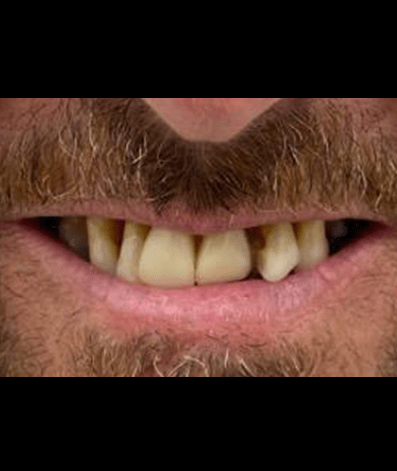 Before - GM Dental & Implant Centre