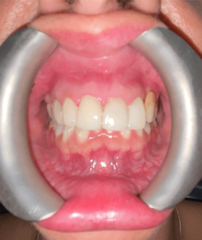 After - GM Dental & Implant Centre