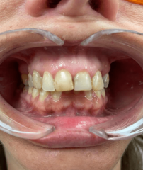 Before - GM Dental & Implant Centre