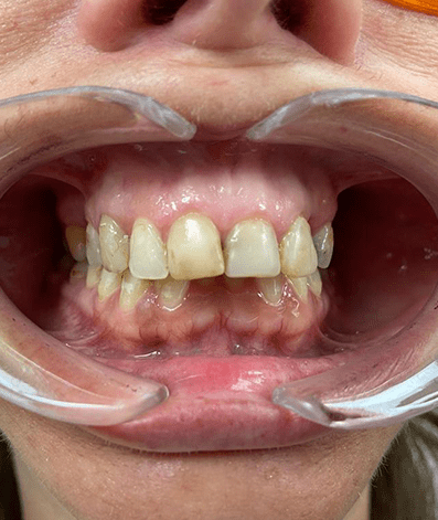 Before - GM Dental & Implant Centre