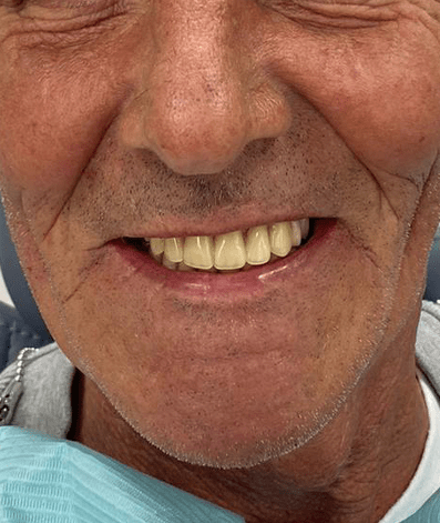 After - GM Dental & Implant Centre