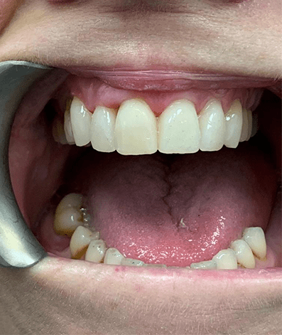 After - GM Dental & Implant Centre