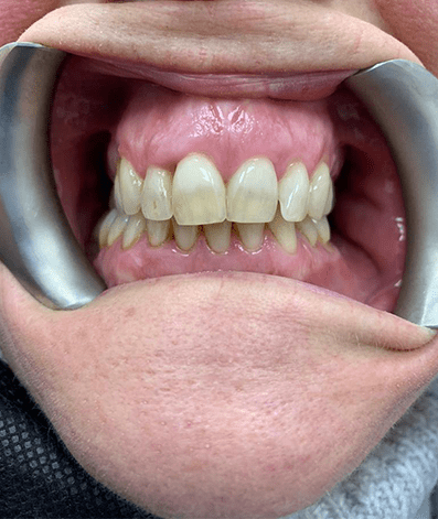 Before - GM Dental & Implant Centre