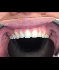 After - GM Dental & Implant Centre