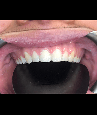 After - GM Dental & Implant Centre