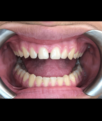 Before - GM Dental & Implant Centre