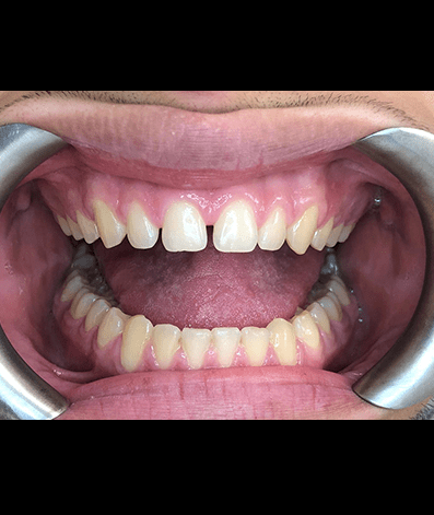 Before - GM Dental & Implant Centre