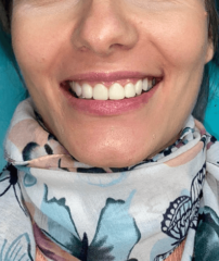 After - GM Dental & Implant Centre