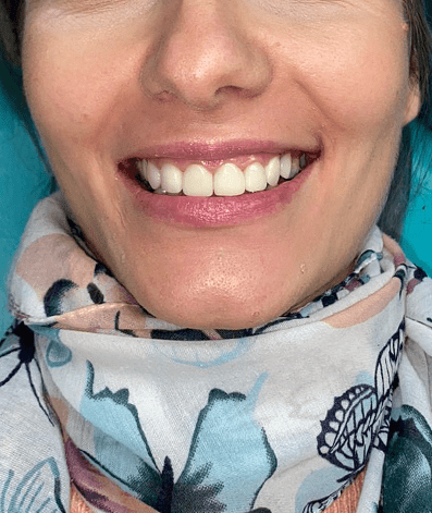 After - GM Dental & Implant Centre