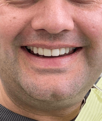 After - GM Dental & Implant Centre