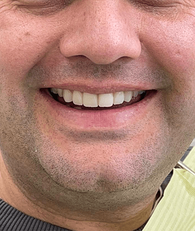 After - GM Dental & Implant Centre