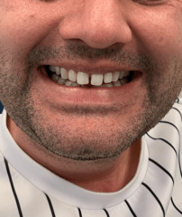 Before - GM Dental & Implant Centre