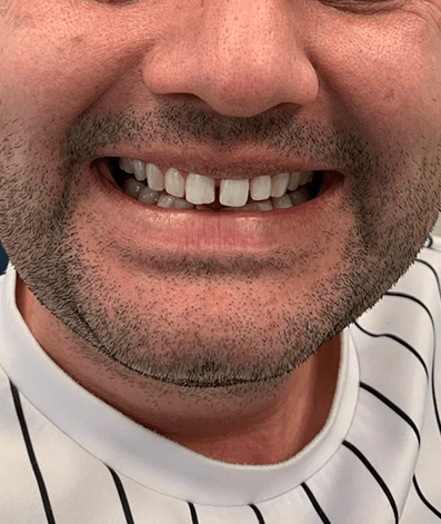 Before - GM Dental & Implant Centre