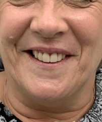 After - GM Dental & Implant Centre