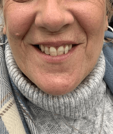 Before - GM Dental & Implant Centre