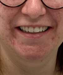 After - GM Dental & Implant Centre