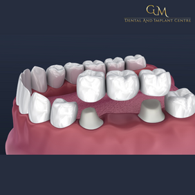 Dental Bridge