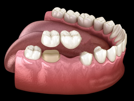 Cantilever Tooth Bridge
