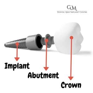 Dental Implant
