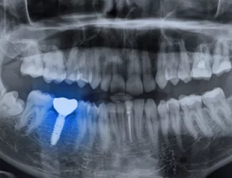 Dental implant Xray