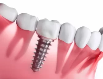 Dental Implant in Rochester, Barnet, Ashford and Rye