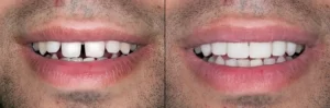 Veneers Before And After