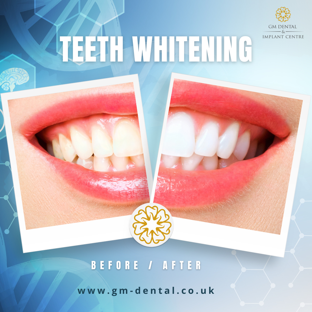 Teeth Whitening At GM Dental And Implant Centre (London