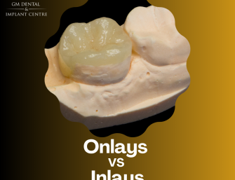 Dental Onlay VS Inlay