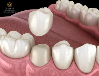 Dental Crowns