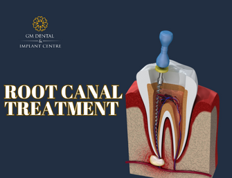 Root Canal Treatment