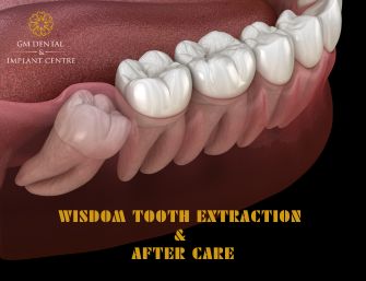 Wisdom Tooth and After Care