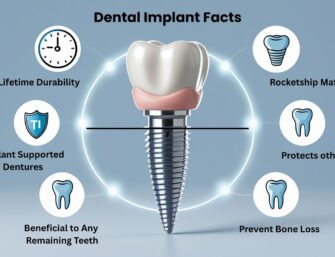 Dental Implants Facts