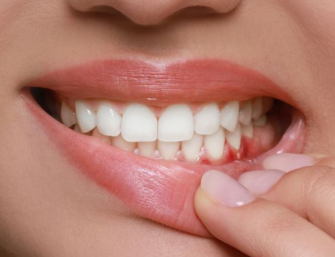 showing receding gums