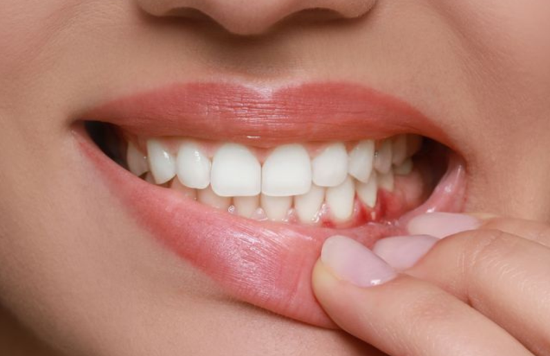 showing receding gums