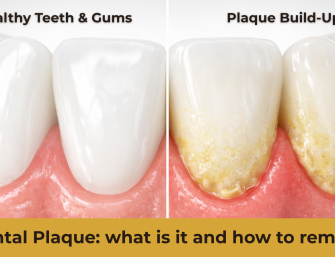 Dental plaque buildup vs healthy teeth illustration