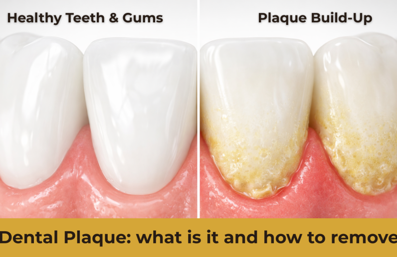Dental plaque buildup vs healthy teeth illustration
