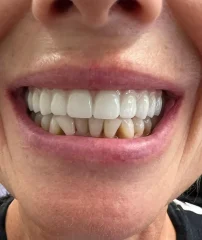 Case 14 After