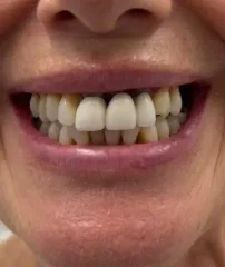 Case 14 Before