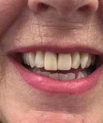 Case 11 After