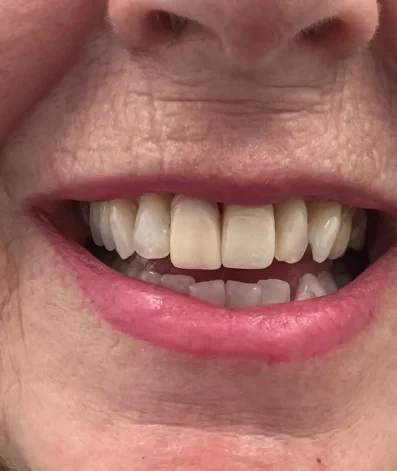Case 11 After