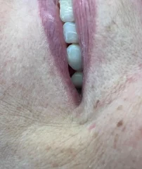 Case 14 After