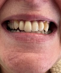 Case 20 After