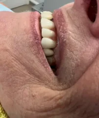 Dental Implant Case 10 After